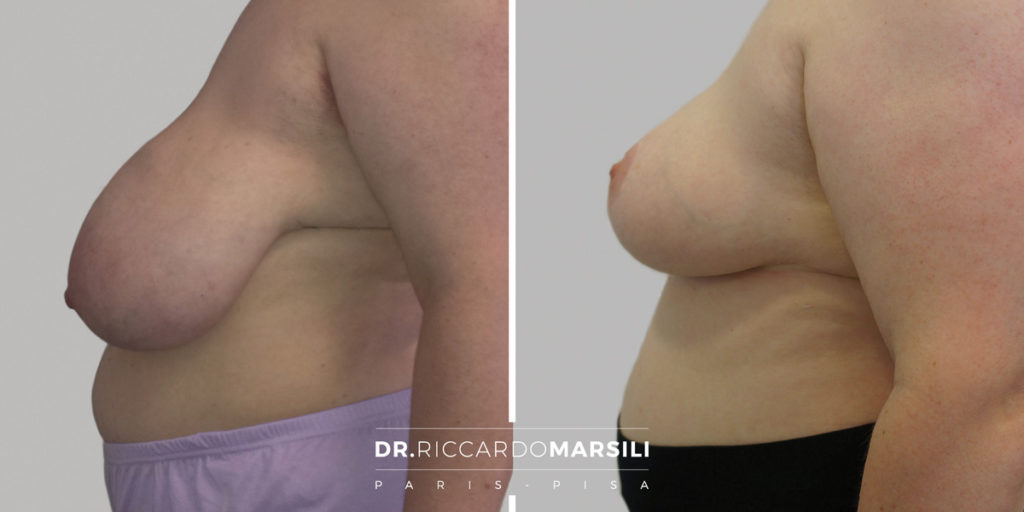 Mastopexie Paris