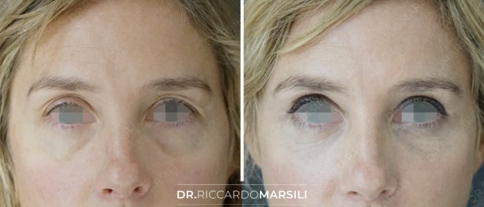 photo-avant-apres-chirurgie-paupiere-dr-marsili-paris Chirurgie des paupières avant et après
