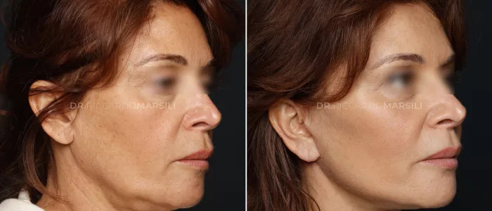 Deep-Plane-Lifting-Paris Deep Plane Lifting Paris