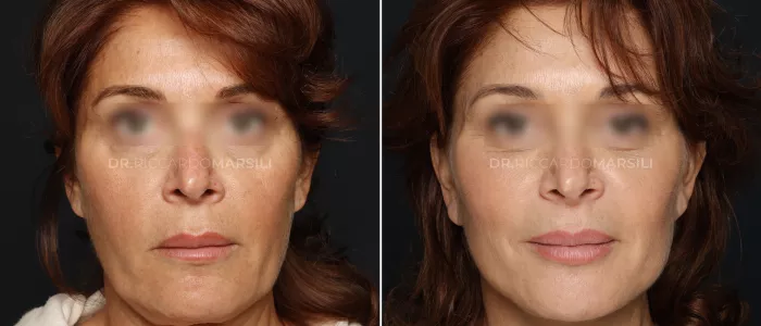 Lifting-Paris-Deep-Plane Lifting Paris Deep Plane