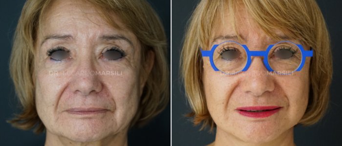 Deep plane Deep plane