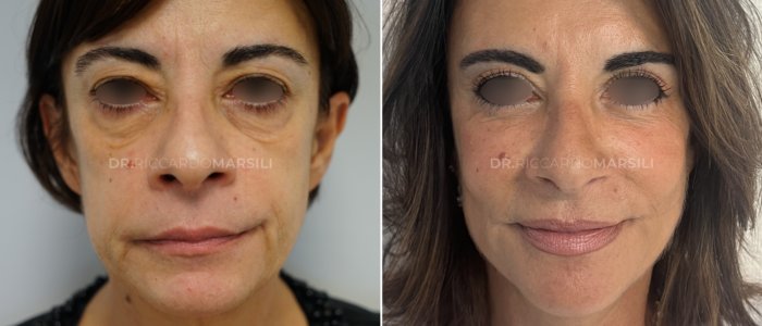 Deep plane Lifting Deep plane Lifting