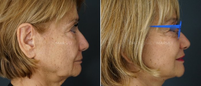 Deep plane lateral Deep plane lateral