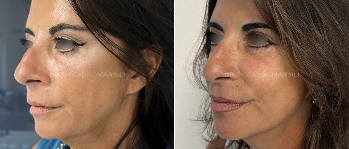 Lifting deep plane lateral Lifting deep plane lateral