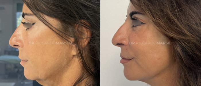 deep plane lift deep plane lift